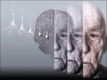La maladie de Parkinson